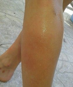 Pierna con aloe vera